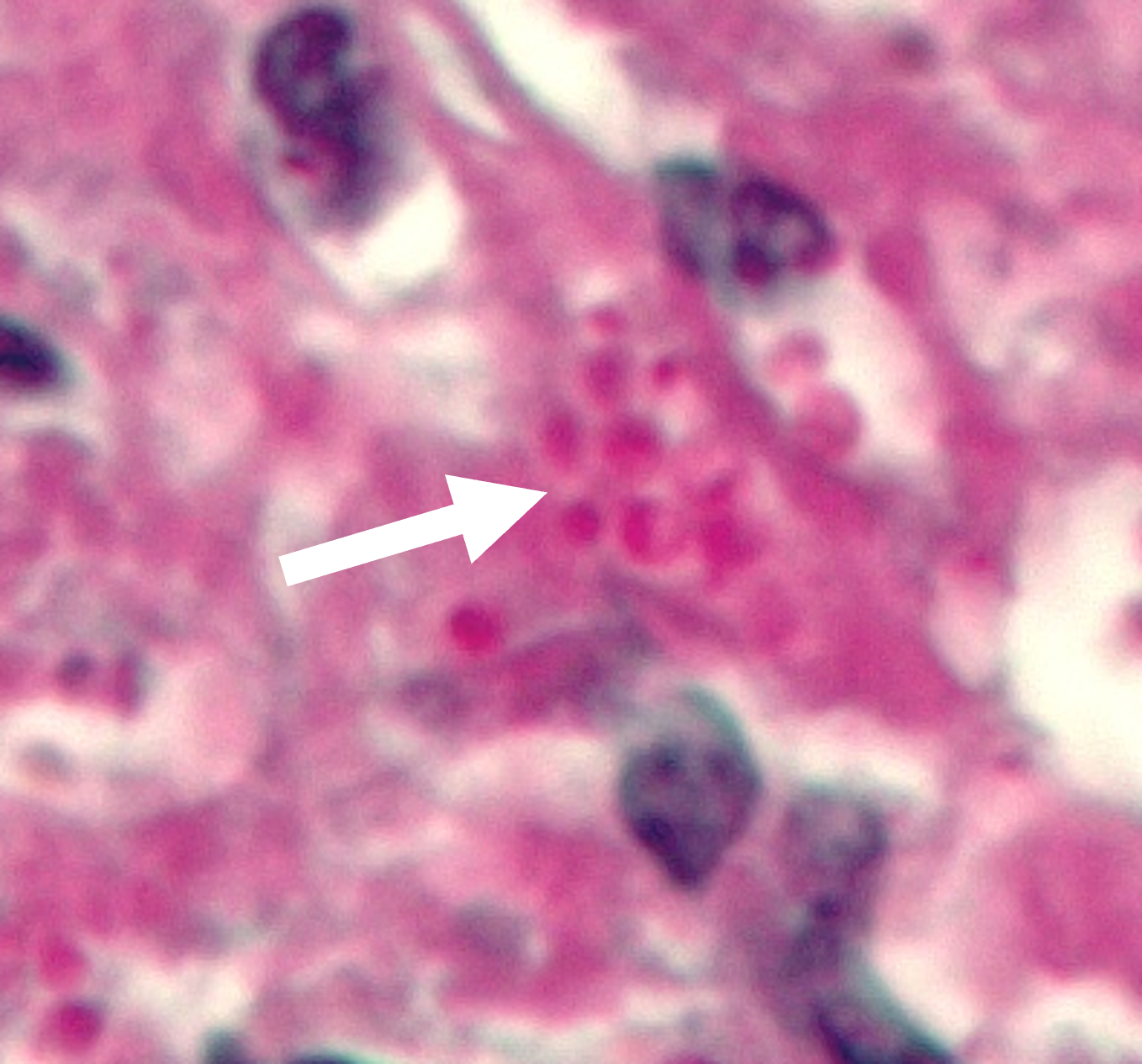 Histoplasmose (Leber)